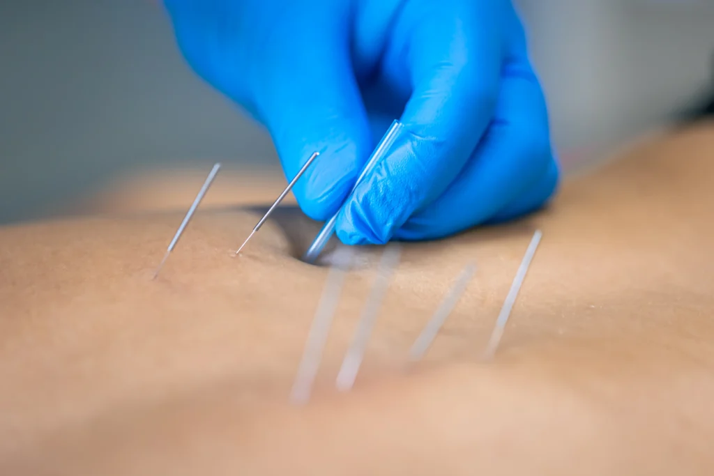 fisioterapia invasiva en rivas vaciamadrid